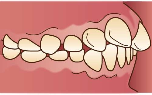 上顎前突（じょうがくぜんとつ）