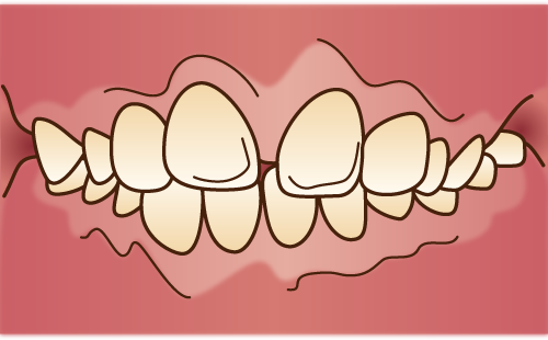 上下顎前突（じょうかがくぜんとつ）